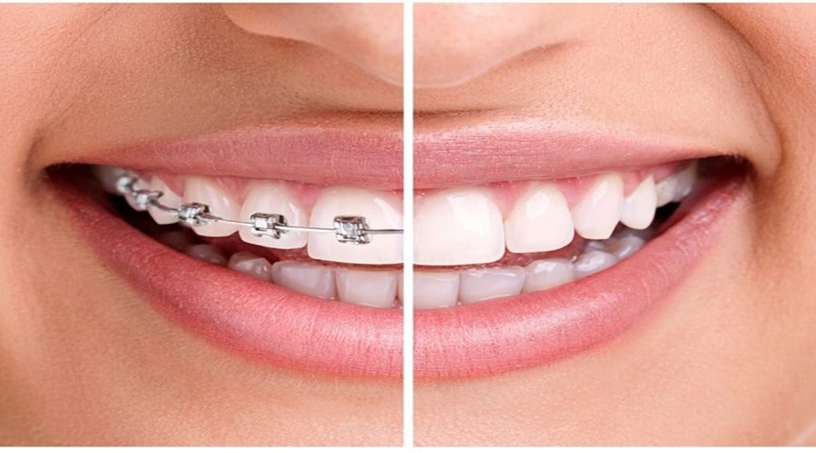 Types of orthodontics